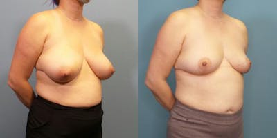 Breast Reduction Before & After Gallery - Patient 700265 - Image 2
