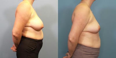 Breast Reduction Before & After Gallery - Patient 700265 - Image 3