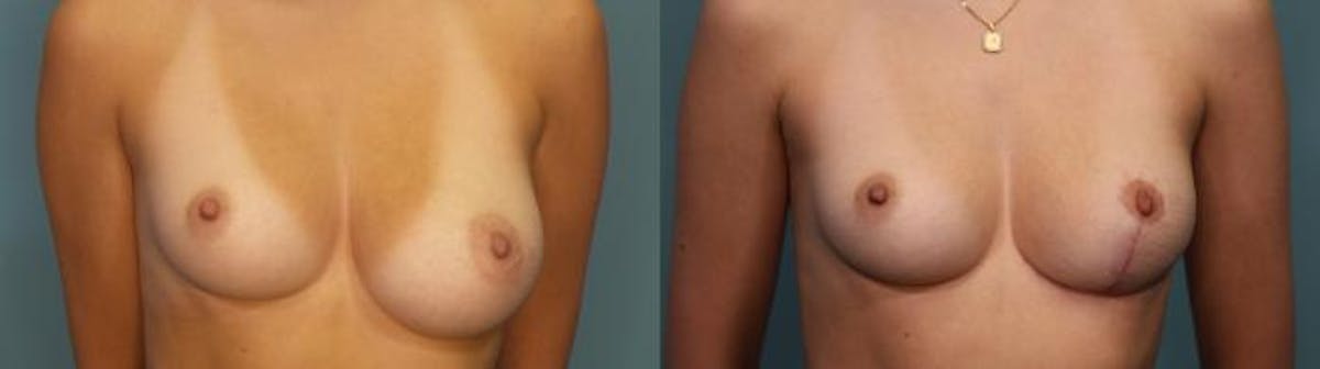 Breast Reduction Before & After Gallery - Patient 205791 - Image 1