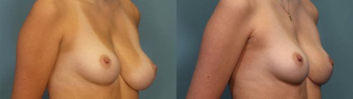 Breast Reduction Before & After Gallery - Patient 205791 - Image 2
