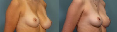 Breast Reduction Before & After Gallery - Patient 205791 - Image 2