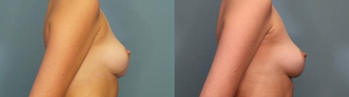 Breast Reduction Before & After Gallery - Patient 205791 - Image 3