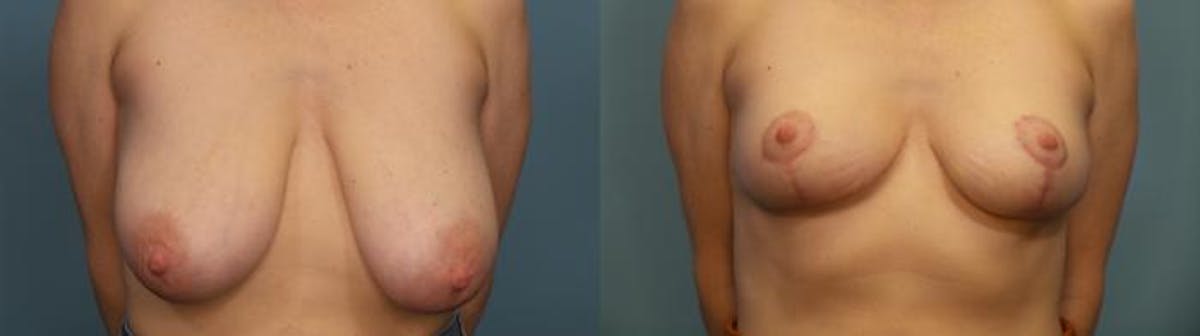 Breast Reduction Before & After Gallery - Patient 418231 - Image 1