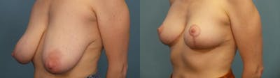 Breast Reduction Before & After Gallery - Patient 418231 - Image 2