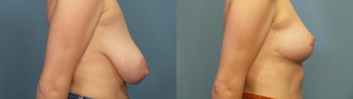 Breast Reduction Before & After Gallery - Patient 418231 - Image 3