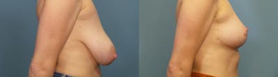 Breast Reduction Before & After Gallery - Patient 418231 - Image 3