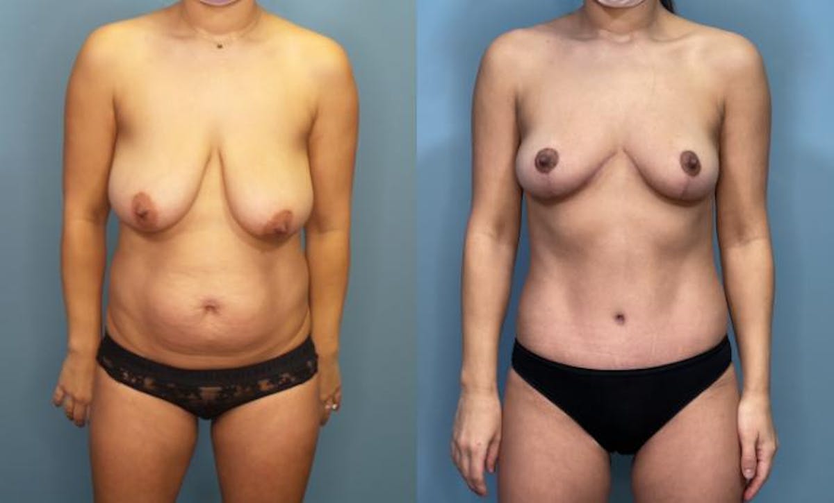 Breast Reduction Before & After Gallery - Patient 161104 - Image 1