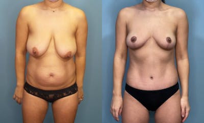 Breast Reduction Before & After Gallery - Patient 161104 - Image 1