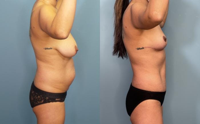 Breast Reduction Before & After Gallery - Patient 161104 - Image 2