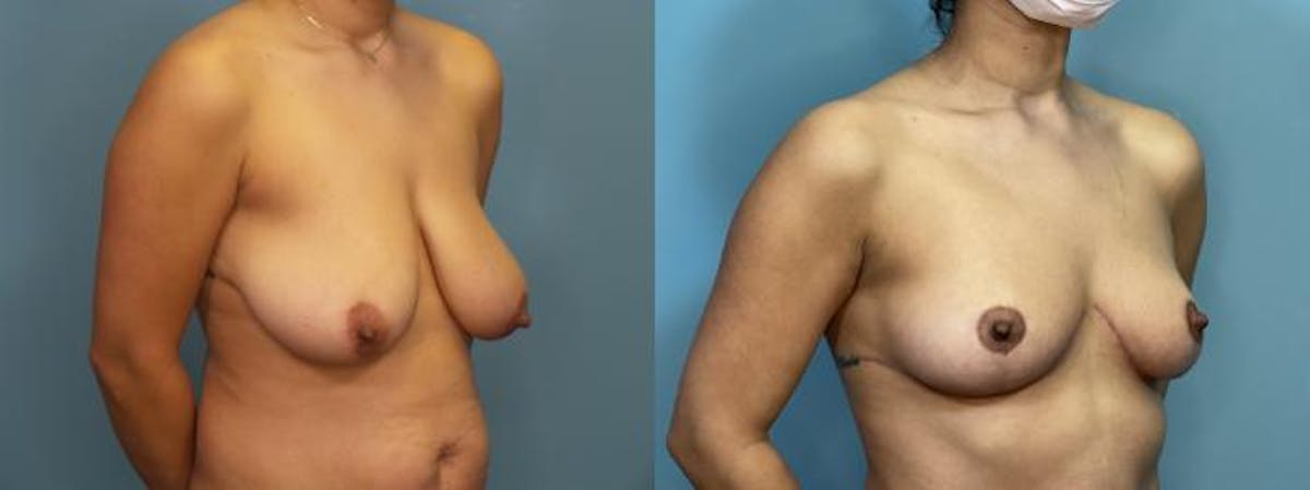 Breast Reduction Before & After Gallery - Patient 161104 - Image 3