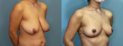 Breast Reduction Before & After Gallery - Patient 161104 - Image 3