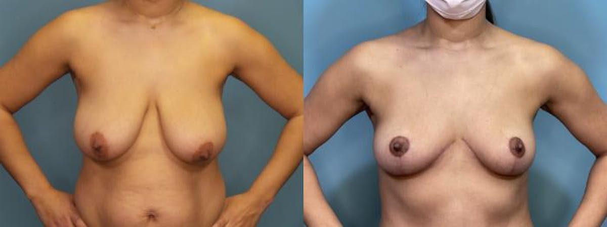 Breast Reduction Before & After Gallery - Patient 161104 - Image 4