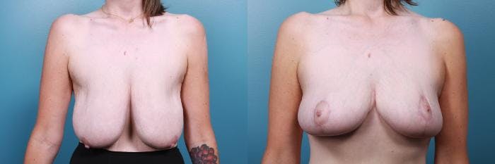 Breast Reduction Before & After Gallery - Patient 301398 - Image 1