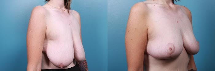 Breast Reduction Before & After Gallery - Patient 301398 - Image 2