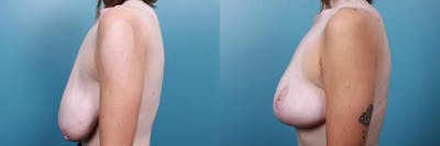 Breast Reduction Before & After Gallery - Patient 301398 - Image 3