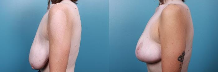 Breast Reduction Before & After Gallery - Patient 301398 - Image 3