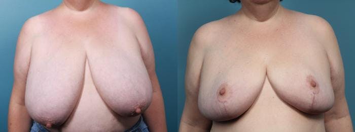 Breast Reduction Before & After Gallery - Patient 679904 - Image 1