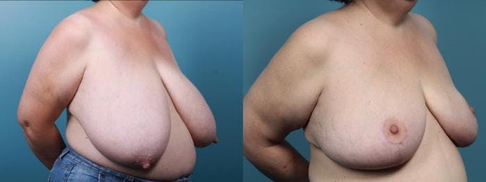 Breast Reduction Before & After Gallery - Patient 679904 - Image 2
