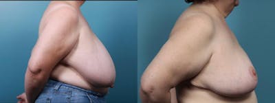 Breast Reduction Before & After Gallery - Patient 679904 - Image 3