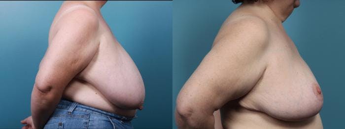 Breast Reduction Before & After Gallery - Patient 679904 - Image 3
