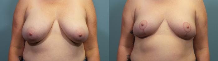 Breast Reduction Before & After Gallery - Patient 787523 - Image 1