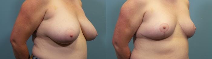 Breast Reduction Before & After Gallery - Patient 787523 - Image 2