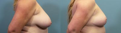 Breast Reduction Before & After Gallery - Patient 787523 - Image 3