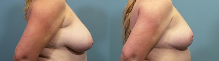 Breast Reduction Before & After Gallery - Patient 787523 - Image 3