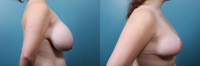 Breast Reduction Before & After Gallery - Patient 336885 - Image 2