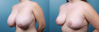 Breast Reduction Before & After Gallery - Patient 336885 - Image 3