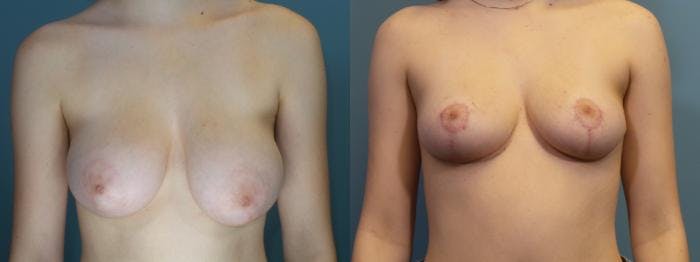 Breast Reduction Before & After Gallery - Patient 350894 - Image 1
