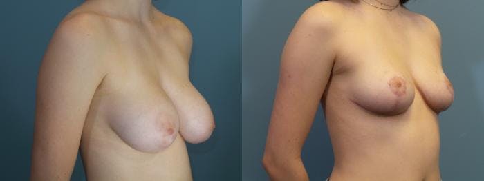 Breast Reduction Before & After Gallery - Patient 350894 - Image 2