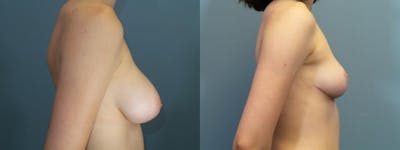 Breast Reduction Before & After Gallery - Patient 350894 - Image 3