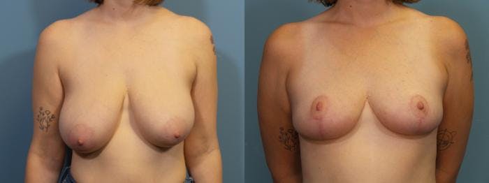 Breast Reduction Before & After Gallery - Patient 285094 - Image 1