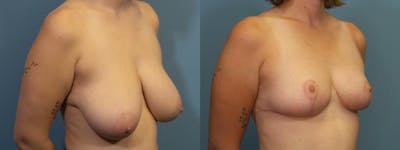 Breast Reduction Before & After Gallery - Patient 285094 - Image 2