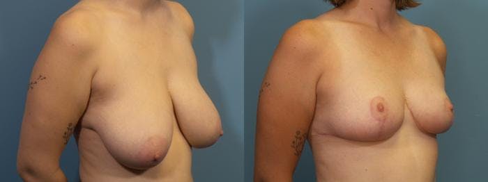 Breast Reduction Before & After Gallery - Patient 285094 - Image 2