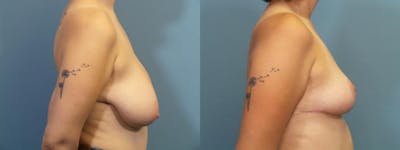 Breast Reduction Before & After Gallery - Patient 285094 - Image 3