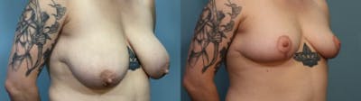 Breast Reduction Before & After Gallery - Patient 248684 - Image 2