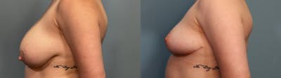 Breast Reduction Before & After Gallery - Patient 248684 - Image 3