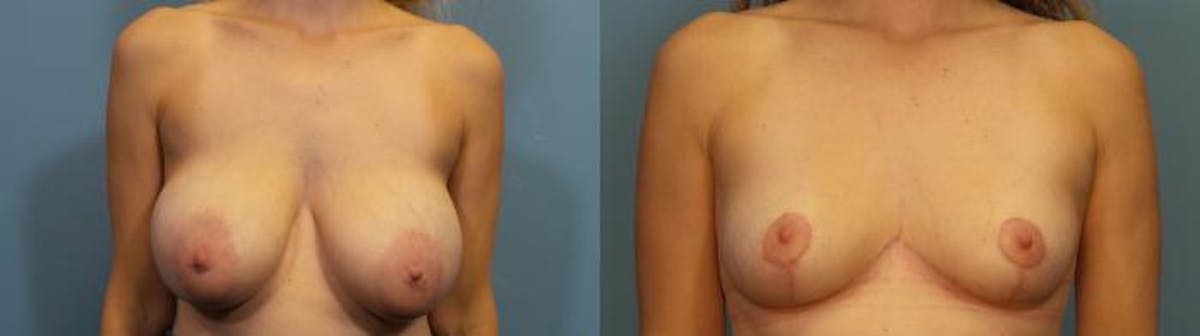 Breast Reduction Before & After Gallery - Patient 418993 - Image 1