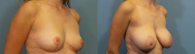 Breast Reduction Before & After Gallery - Patient 418993 - Image 2