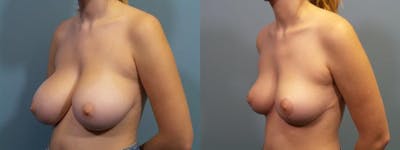 Breast Reduction Before & After Gallery - Patient 301221 - Image 2