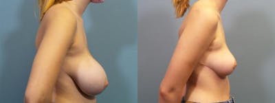 Breast Reduction Before & After Gallery - Patient 301221 - Image 3