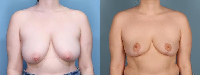 Breast Reduction Before & After Gallery - Patient 104409 - Image 1