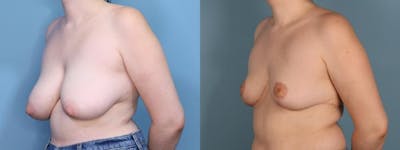 Breast Reduction Before & After Gallery - Patient 104409 - Image 2