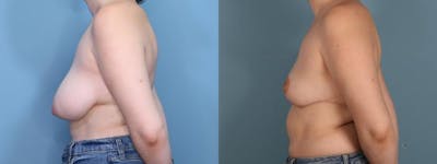 Breast Reduction Before & After Gallery - Patient 104409 - Image 3