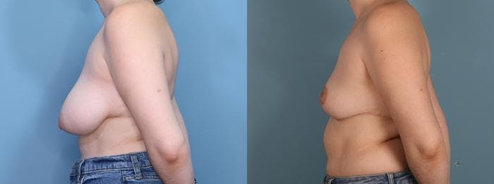 Breast Reduction Before & After Gallery - Patient 104409 - Image 3