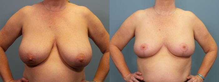 Breast Reduction Before & After Gallery - Patient 223918 - Image 1
