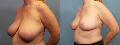 Breast Reduction Before & After Gallery - Patient 223918 - Image 2