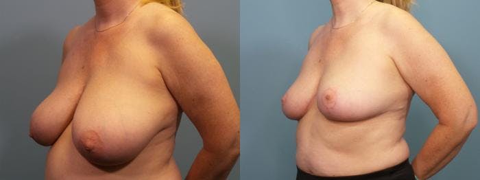 Breast Reduction Before & After Gallery - Patient 223918 - Image 2